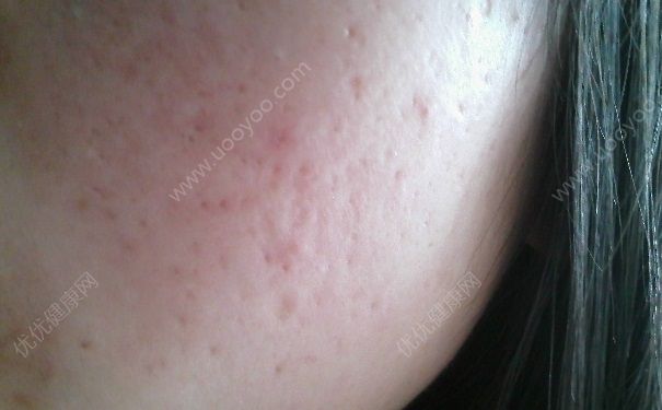 芦荟胶可以去痘印吗？芦荟胶去痘印有效吗？(2)