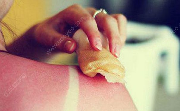 游泳晒伤了怎么办？游泳晒伤如何处理？(2)