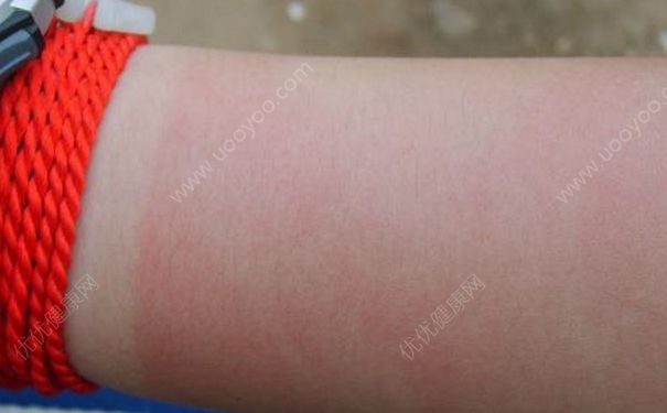 游泳晒伤了怎么办？游泳晒伤如何处理？(1)