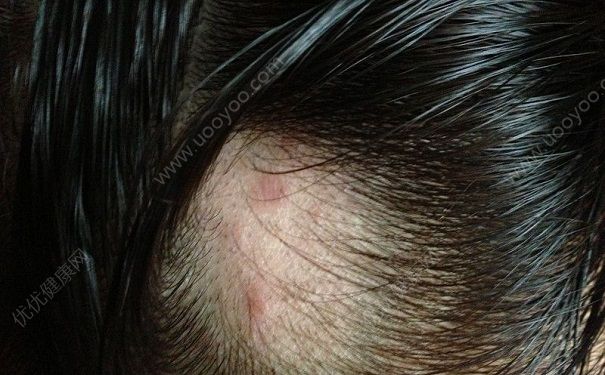 天热头上长红疙瘩怎么回事？天热头上长疙瘩怎么办？(2)