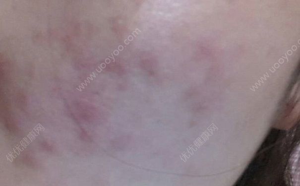 14岁少年脸上长粉刺怎么办？14岁少年脸上为什么会长粉刺？(2)