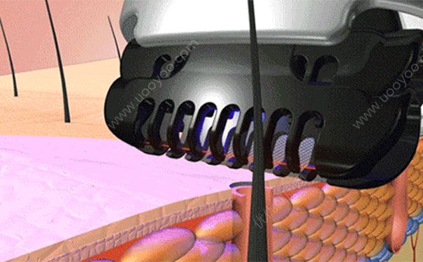 冰点脱毛可以保持多久？冰点脱毛能维持多久？(2)