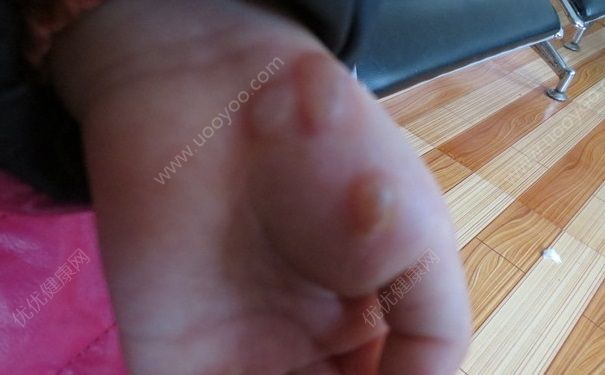 15岁还会得手足口病吗？手足口病的症状有哪些？(3)