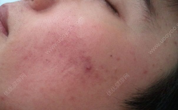 16岁脸上有痘印怎么办？脸上有痘印怎么消除？(1)