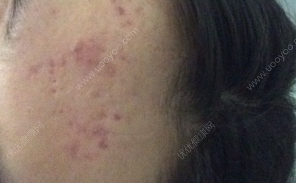 16岁脸上有痘印怎么办？脸上有痘印怎么消除？(2)