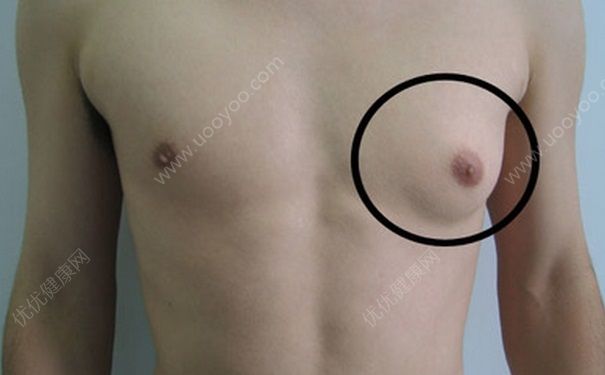 男生会得乳腺癌吗？男生得乳腺癌的症状(1)