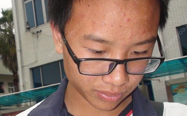 光子嫩肤可以祛痘吗？光子嫩肤可以去痘坑吗？(3)