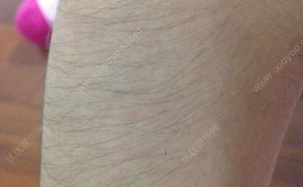 17岁男生体毛长怎么办？男生体毛过多怎么回事？(3)