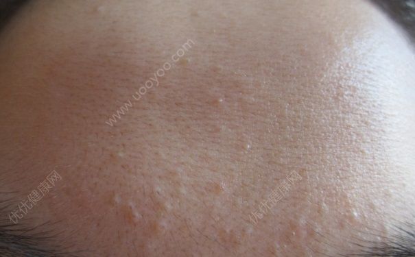 闭口粉刺是什么？闭口粉刺怎么去除？(2)