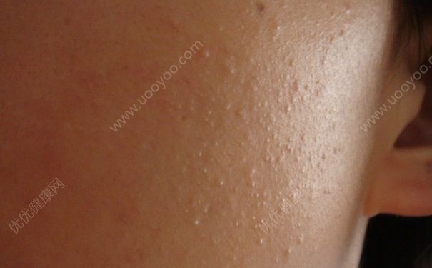 闭口粉刺是什么？闭口粉刺怎么去除？(1)