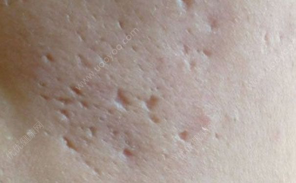 痘坑怎么修复？痘坑如何消除？(1)