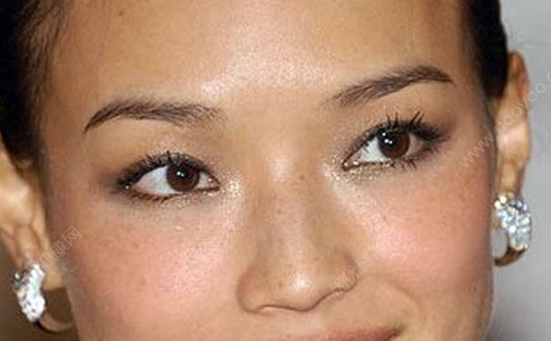 黄褐斑如何彻底治疗？黄褐斑如何去除？(2)