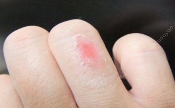 烫伤后怎么处理？烫伤起泡怎么处理？(6)