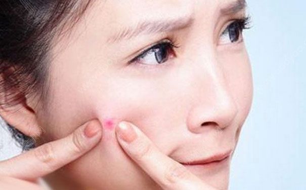 皮肤出油长痘怎么办？如何控油祛痘(1)