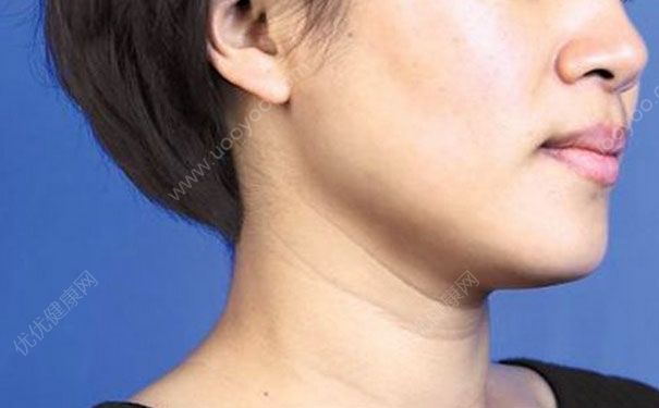 如何按摩去颈纹？去颈纹最有效的方法(1)