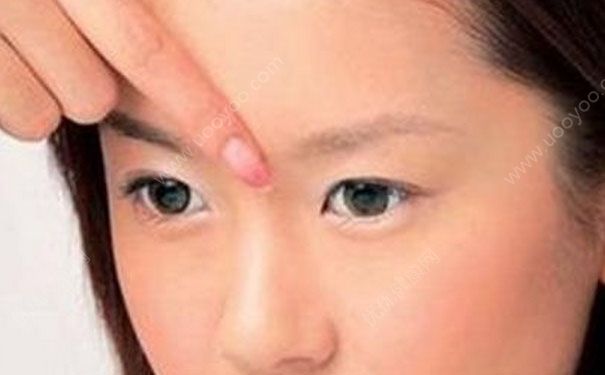 抬头纹如何去除？去除抬头纹的方法(6)