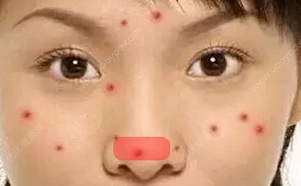 鼻子上长痘痘怎么办？鼻子上长痘痘怎么去掉？(6)