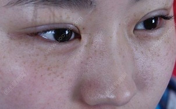 雀斑是怎么形成的？雀斑可以去掉吗？(2)