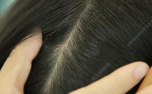 头发老是出油是什么原因？头发老是出油怎么办？[多图]
