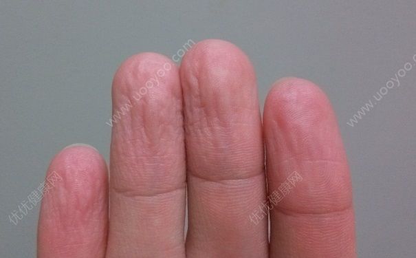 手泡水里为什么会皱？手泡水后发白起皱怎么办？[多图]