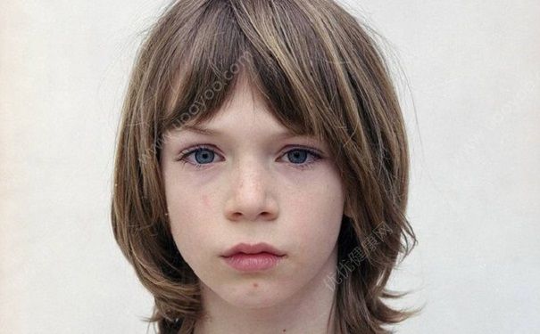 青少年有雀斑怎么去除？青少年怎样去雀斑？(1)