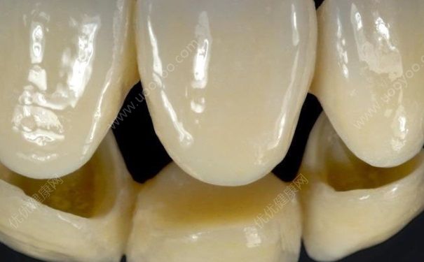 金属烤瓷牙有副作用吗？金属烤瓷牙的危害[多图]