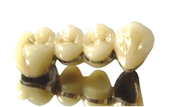 金属烤瓷牙有副作用吗？金属烤瓷牙的危害(4)