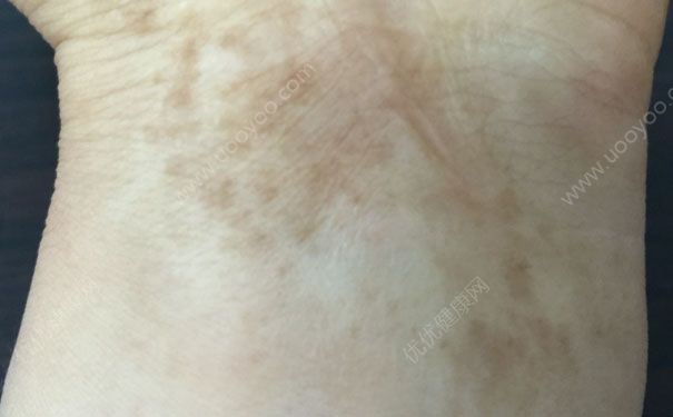 烫伤疤痕怎样恢复快？烫伤疤痕如何消除？(2)
