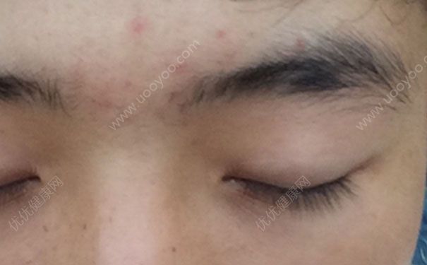 眉毛上长痘痘是什么原因？眉毛上长痘痘怎么办？(2)