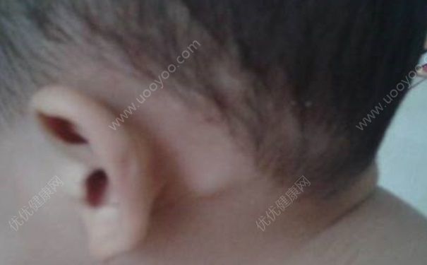 摸到淋巴结正常吗？突然摸到淋巴结肿大(4)