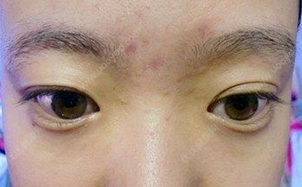 眉毛上长痘痘是什么原因？眉毛上长痘痘怎么办？[多图]