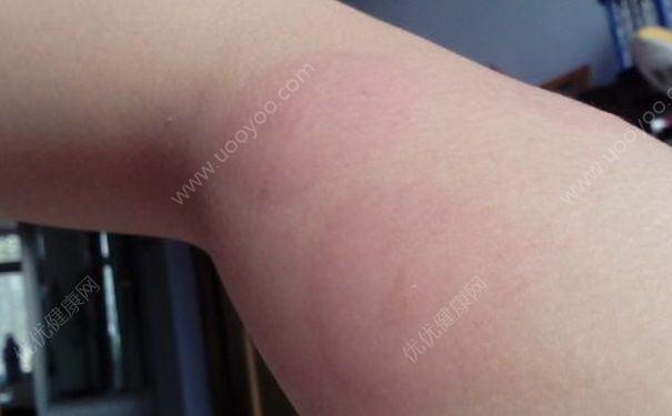 荨麻疹是怎么引起的？荨麻疹临床表现[多图]