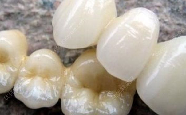 活动假牙影响咀嚼 活动假牙好还是固定假牙好？[图]