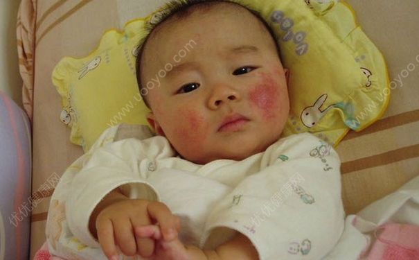 婴儿湿疹吃什么好？婴儿湿疹饮食注意什么？(1)