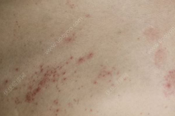 皮肤过敏是什么原因？防治皮肤过敏食疗方(1)