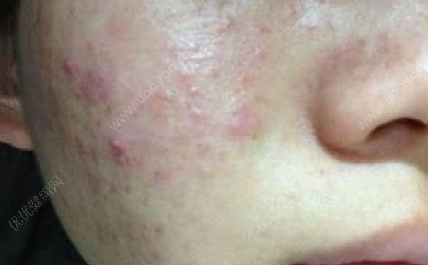 淡化痘印的方法有哪些？怎么淡化痘印痘坑？(1)