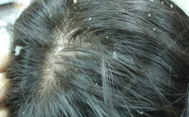 秋冬季头皮屑多 头皮屑多又痒怎么办？(1)