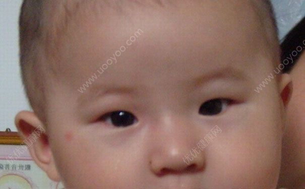 宝宝额头突出高怎么回事？宝宝额头突出高怎么办？(1)