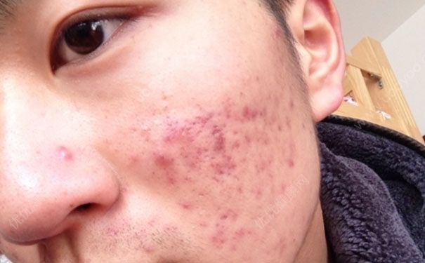 怎样去除痘痘和痘印？快速去除痘痘和痘印的方法(1)