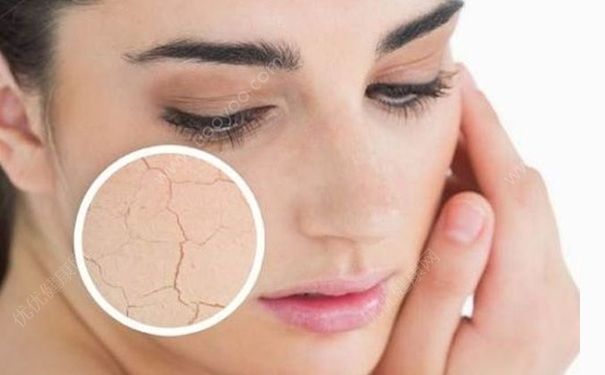 皮肤干燥爆皮是怎么回事？皮肤很干脱皮怎么办？(1)