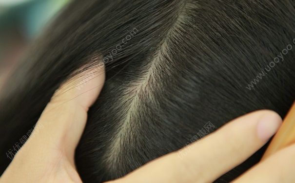 脂溢性脱发怎么办？如何改善脂溢性脱发？[图]