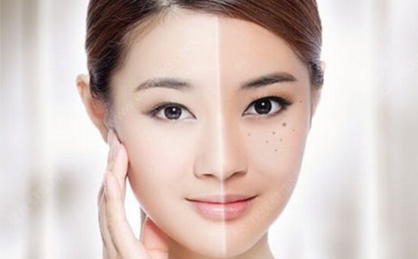 黄褐斑有哪些危害？黄褐斑如何治疗？(1)