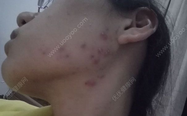 耳垂下面长痘痘是怎么回事？耳垂下长痘痘是什么原因？(1)