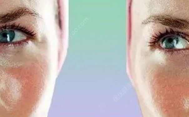 油性皮肤怎么护理？皮肤出油长痘怎么办？(1)