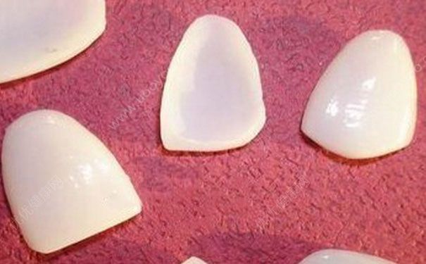 牙齿贴面是什么意思？牙齿贴面好不好？[图]