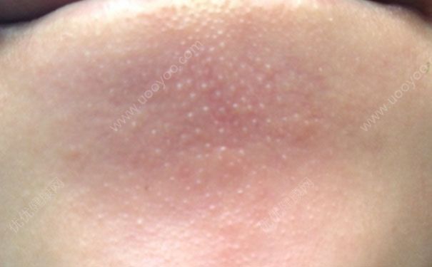 粉刺挤了后怎么处理？挤完粉刺后怎么处理？(1)