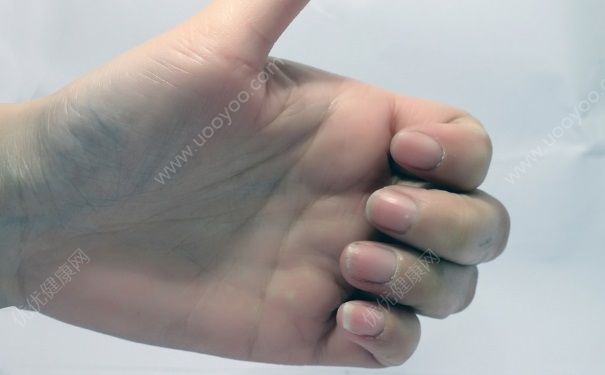 指甲有黑色竖纹是怎么回事？指甲上有黑色竖纹是怎么回