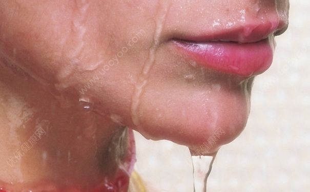 白头粉刺形成的原因是什么？为什么会长白头粉刺？(1)