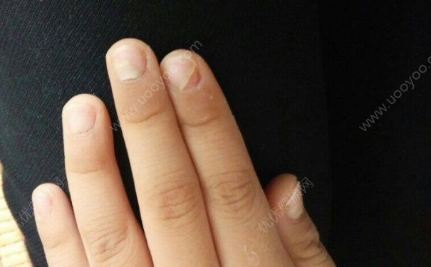 指甲脱落是什么原因？指甲脱落是怎么回事？[图]
