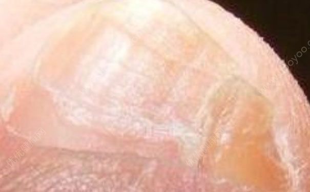 小脚趾甲两瓣是什么原因？小脚趾甲两瓣的传说[图]